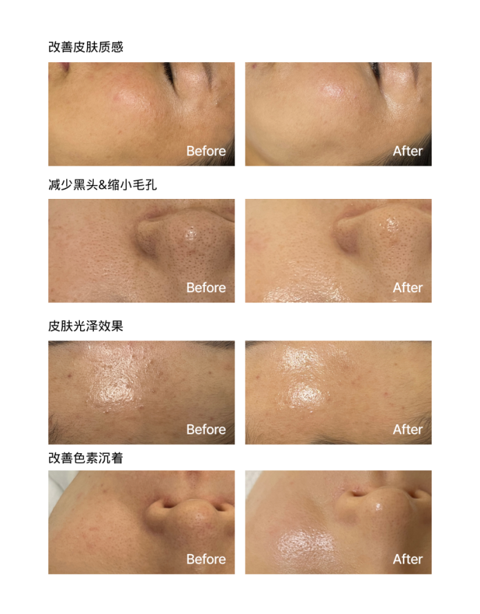 第四代黑科技XE-LHA PEEL